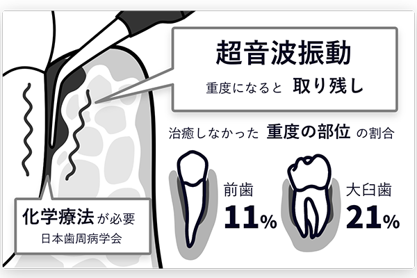 超音波振動のみ